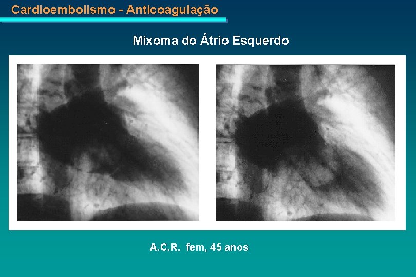 Cardioembolismo - Anticoagulação Mixoma do Átrio Esquerdo A. C. R. fem, 45 anos 