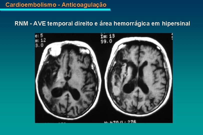 Cardioembolismo - Anticoagulação RNM - AVE temporal direito e área hemorrágica em hipersinal 