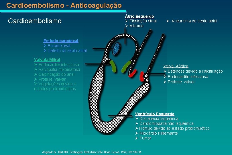 Cardioembolismo - Anticoagulação Cardioembolismo Átrio Esquerdo Fibrilação atrial Mixoma Aneurisma do septo atrial Êmbolo