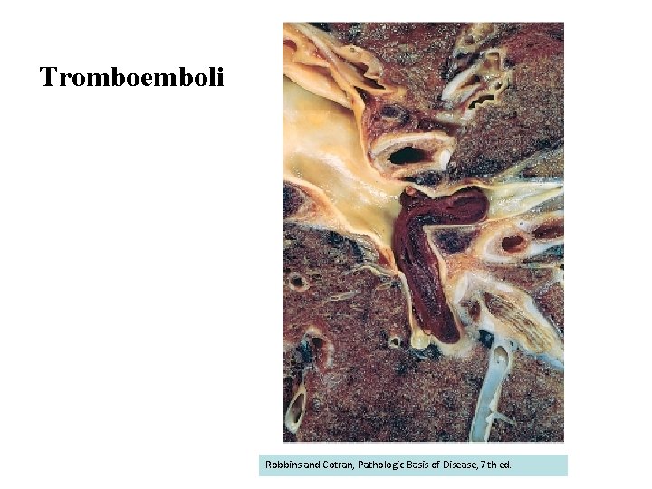 Tromboemboli Robbins and Cotran, Pathologic Basis of Disease, 7 th ed. 