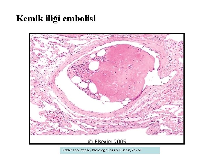 Kemik iliği embolisi Robbins and Cotran, Pathologic Basis of Disease, 7 th ed. 