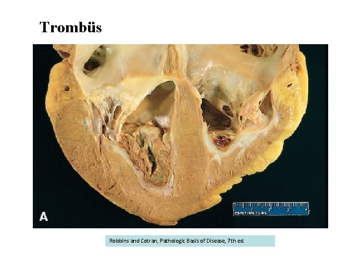 Trombüs Robbins and Cotran, Pathologic Basis of Disease, 7 th ed. 