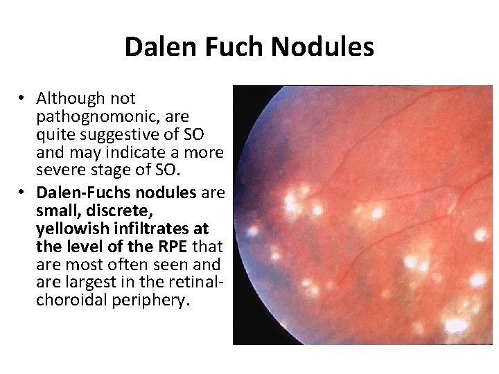 Dalen Fuch Nodules • Although not pathognomonic, are quite suggestive of SO and may