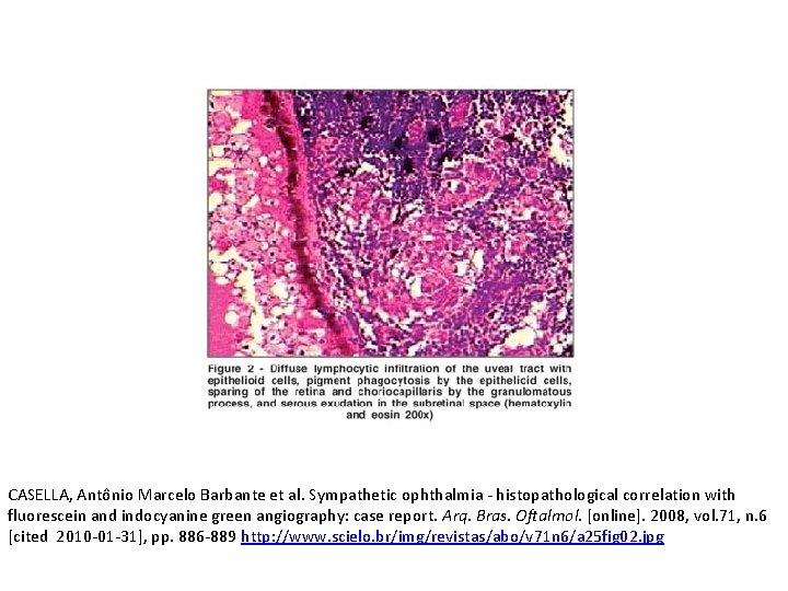 CASELLA, Antônio Marcelo Barbante et al. Sympathetic ophthalmia - histopathological correlation with fluorescein and