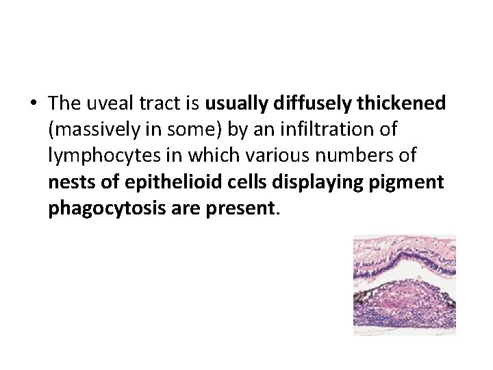  • The uveal tract is usually diffusely thickened (massively in some) by an
