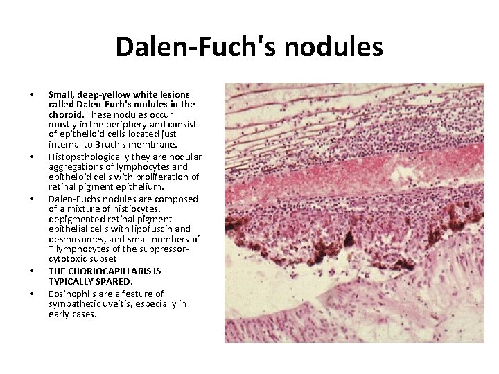 Dalen-Fuch's nodules • • • Small, deep-yellow white lesions called Dalen-Fuch's nodules in the
