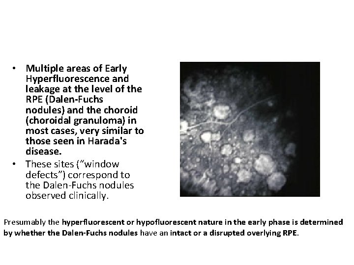  • Multiple areas of Early Hyperfluorescence and leakage at the level of the