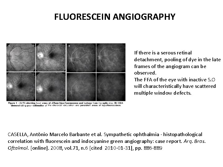 FLUORESCEIN ANGIOGRAPHY If there is a serous retinal detachment, pooling of dye in the