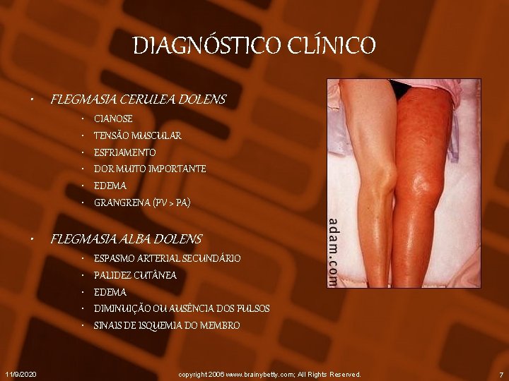 DIAGNÓSTICO CLÍNICO • FLEGMASIA CERULEA DOLENS • • • CIANOSE TENSÃO MUSCULAR ESFRIAMENTO DOR