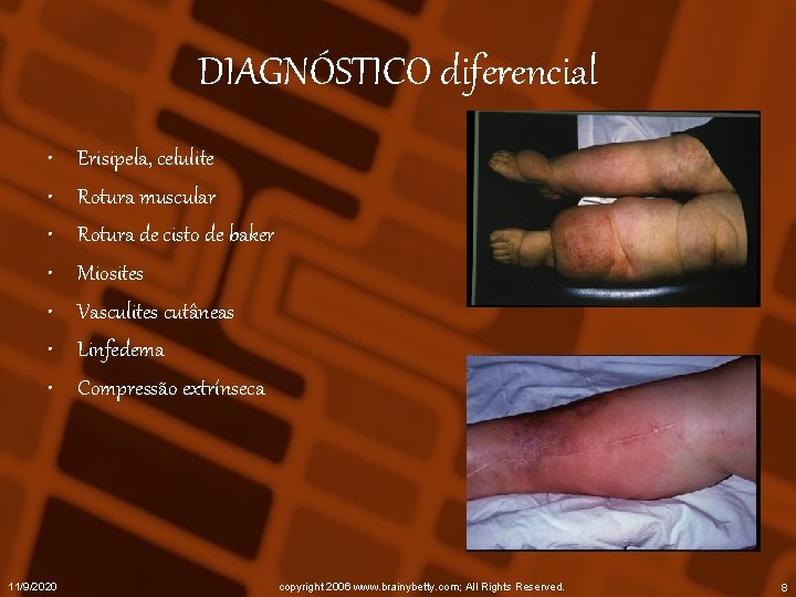 DIAGNÓSTICO diferencial • • 11/9/2020 Erisipela, celulite Rotura muscular Rotura de cisto de baker