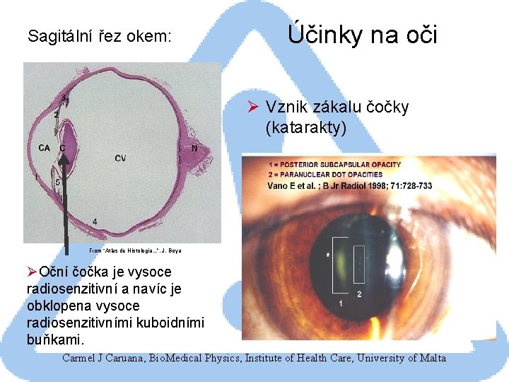 Sagitální řez okem: Účinky na oči Ø Vznik zákalu čočky (katarakty) From “Atlas de