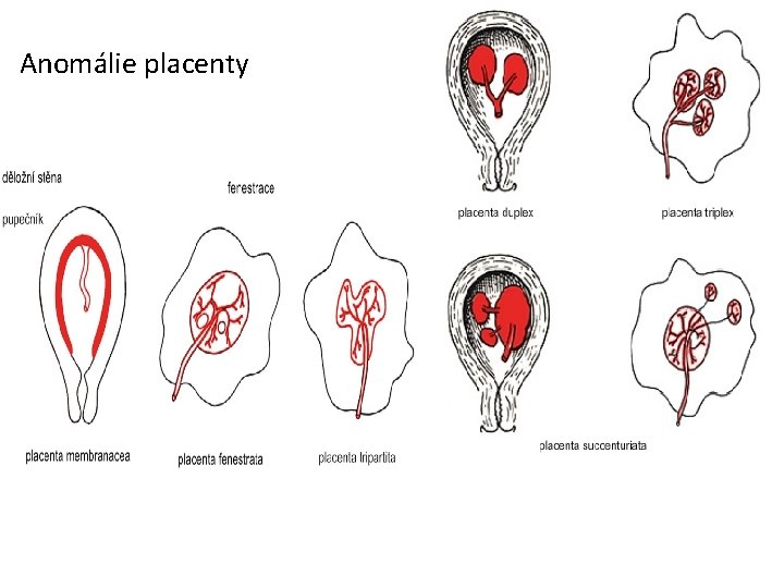 Anomálie placenty 