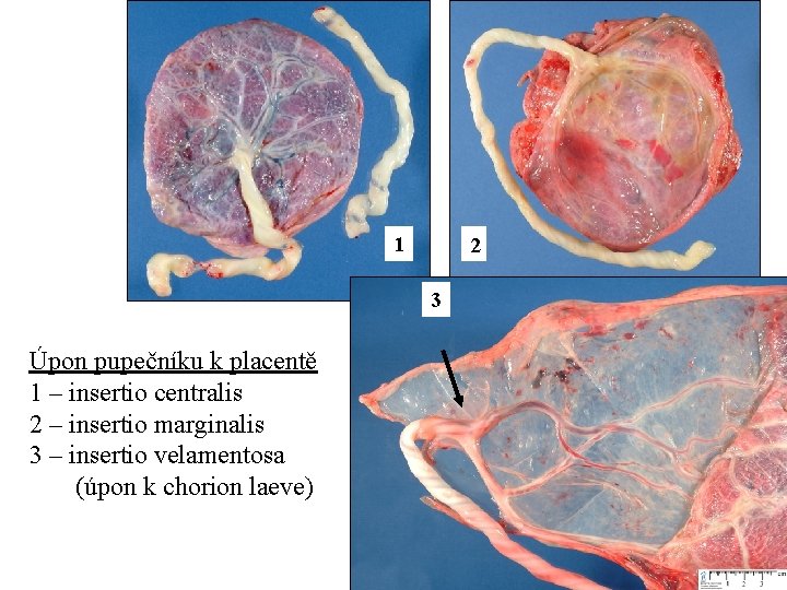 1 2 3 Úpon pupečníku k placentě 1 – insertio centralis 2 – insertio