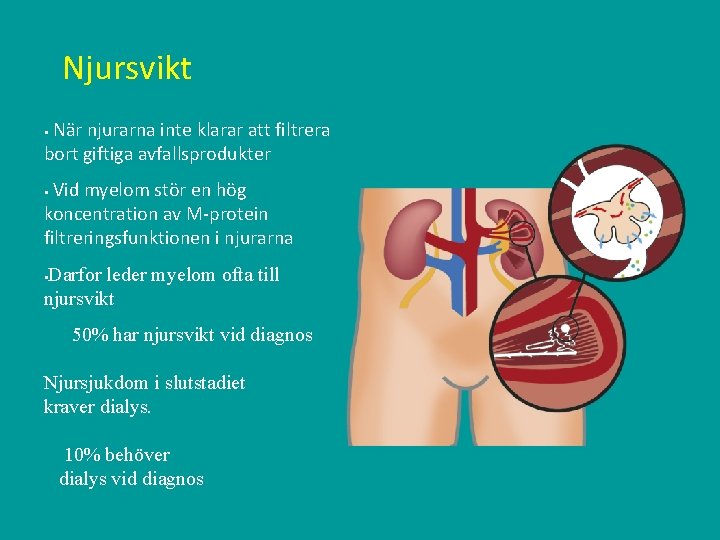 Njursvikt När njurarna inte klarar att filtrera bort giftiga avfallsprodukter § Vid myelom stör