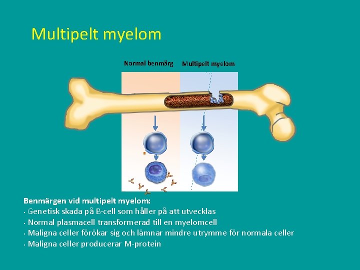 Multipelt myelom Normal benmärg Multipelt myelom Benmärgen vid multipelt myelom: § Genetisk skada på