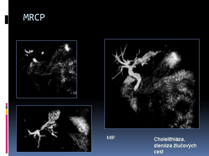 MRCP MIP Cholelithiáza, stenóza žlučových cest 