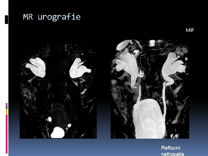 MR urografie MIP Refluxní nefropatie 