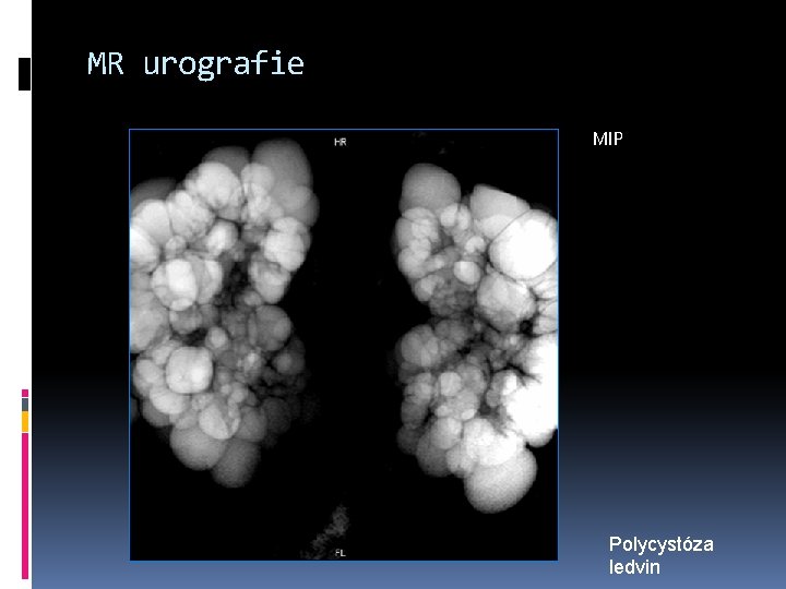 MR urografie MIP Polycystóza ledvin 