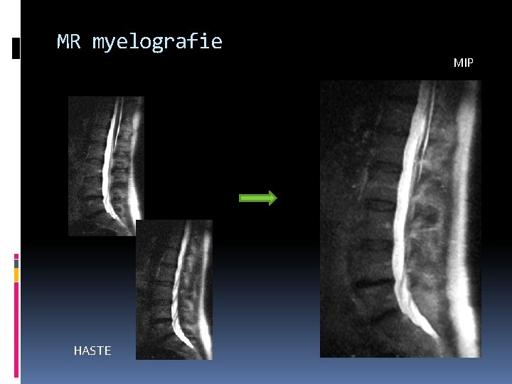 MR myelografie MIP HASTE 