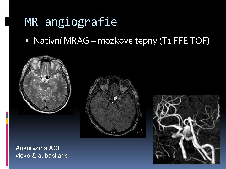 MR angiografie Nativní MRAG – mozkové tepny (T 1 FFE TOF) Aneuryzma ACI vlevo