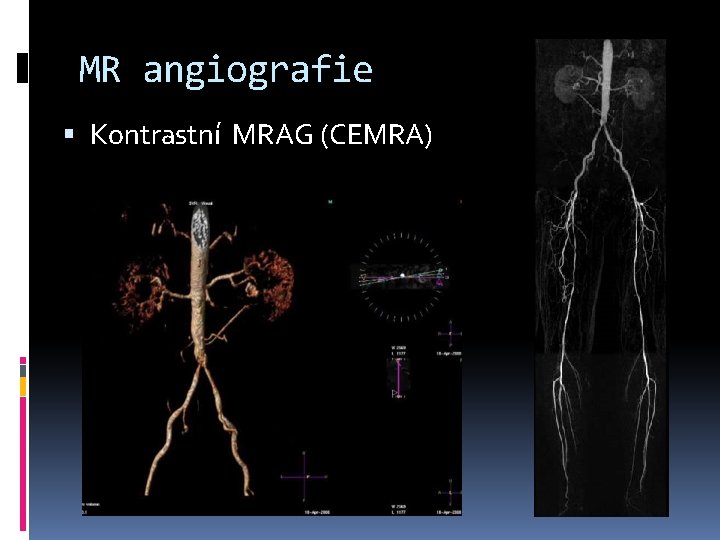 MR angiografie Kontrastní MRAG (CEMRA) 