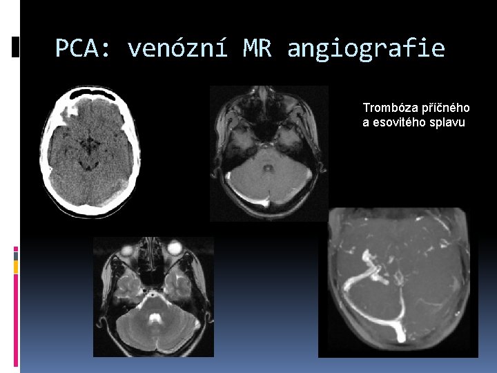 PCA: venózní MR angiografie Trombóza příčného a esovitého splavu 