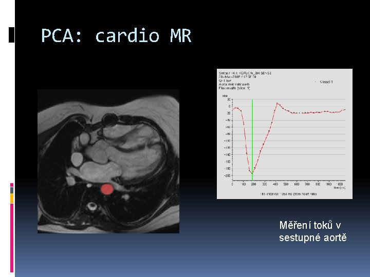 PCA: cardio MR Měření toků v sestupné aortě 