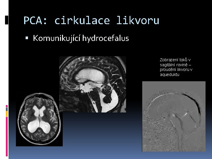 PCA: cirkulace likvoru Komunikující hydrocefalus Zobrazení toků v sagitální rovině – proudění likvoru v