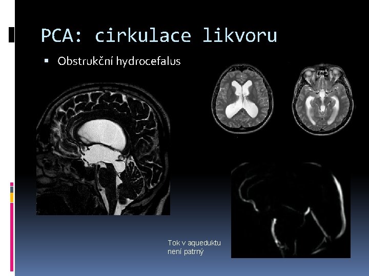 PCA: cirkulace likvoru Obstrukční hydrocefalus Tok v aqueduktu není patrný 