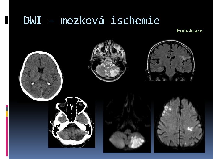 DWI – mozková ischemie Embolizace 