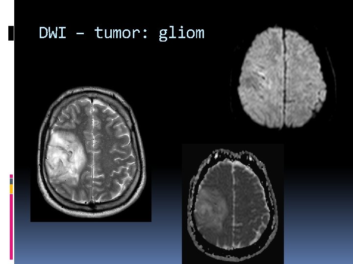 DWI – tumor: gliom 