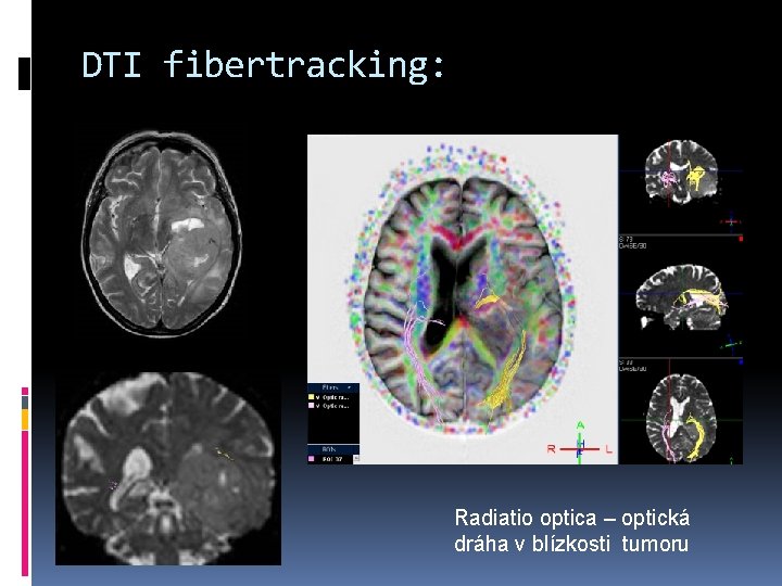 DTI fibertracking: Radiatio optica – optická dráha v blízkosti tumoru 