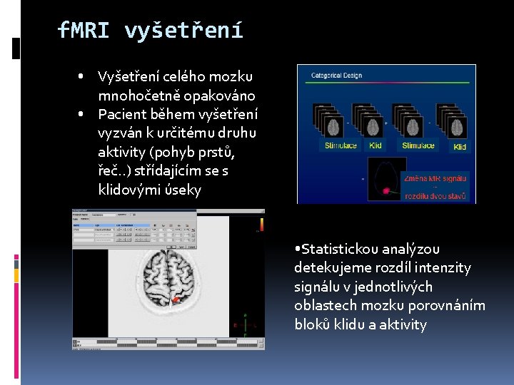 f. MRI vyšetření • Vyšetření celého mozku mnohočetně opakováno • Pacient během vyšetření vyzván
