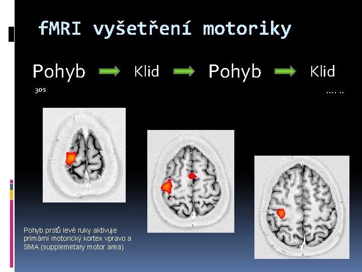 f. MRI vyšetření motoriky Pohyb 30 s Pohyb prstů levé ruky aktivuje primární motorický