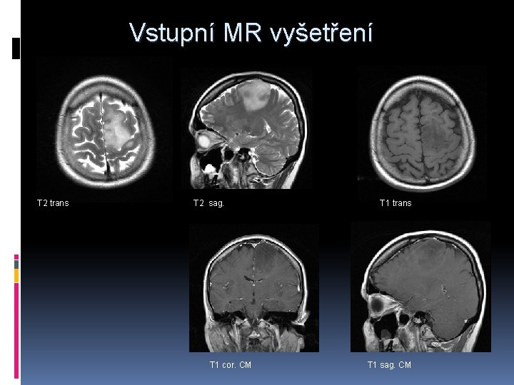 Vstupní MR vyšetření T 2 trans T 2 sag. T 1 cor. CM T