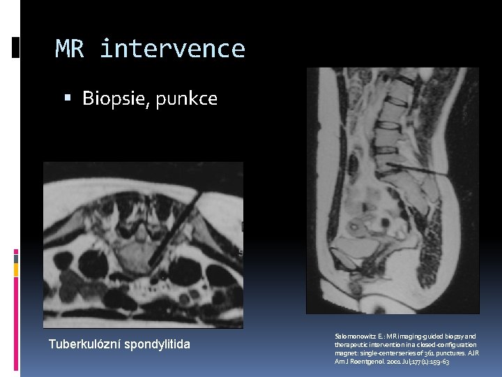 MR intervence Biopsie, punkce Tuberkulózní spondylitida Salomonowitz E. : MR imaging-guided biopsy and therapeutic