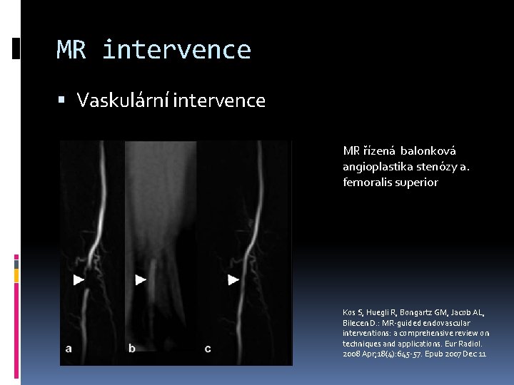 MR intervence Vaskulární intervence MR řízená balonková angioplastika stenózy a. femoralis superior Kos S,