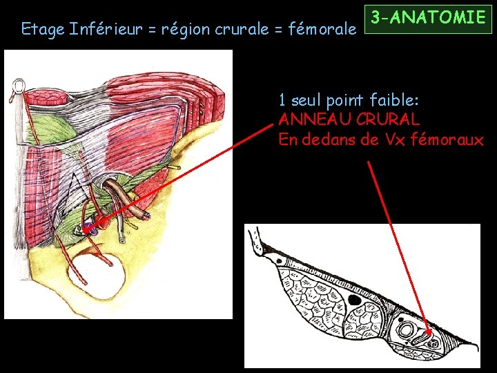 Etage Inférieur = région crurale = fémorale 3 -ANATOMIE 1 seul point faible: ANNEAU