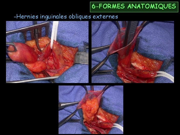 6 -FORMES ANATOMIQUES -Hernies inguinales obliques externes 