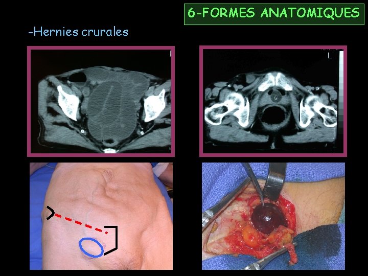 6 -FORMES ANATOMIQUES -Hernies crurales 