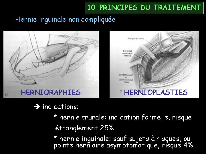 10 -PRINCIPES DU TRAITEMENT -Hernie inguinale non compliquée HERNIORAPHIES HERNIOPLASTIES indications: * hernie crurale: