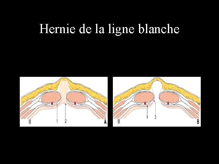 Hernie de la ligne blanche 