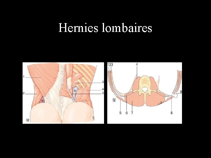 Hernies lombaires 