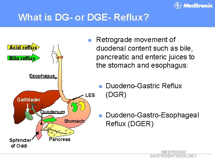 What is DG- or DGE- Reflux? n Acid reflux Bile reflux Retrograde movement of