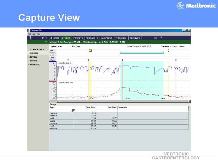 Capture View MEDTRONIC GASTROENTEROLOGY 