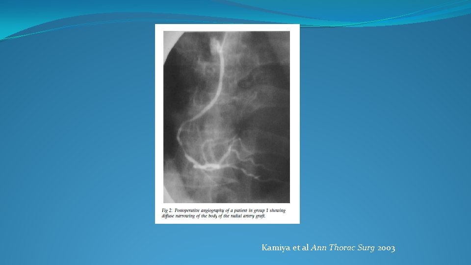 Kamiya et al Ann Thorac Surg 2003 