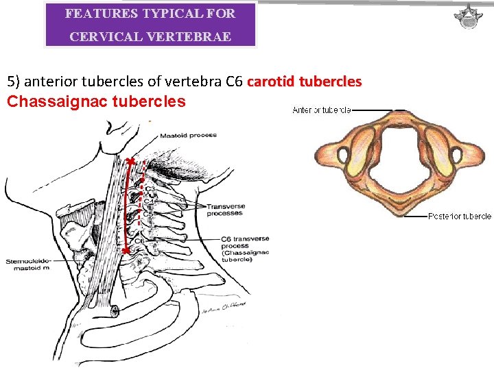 FEATURES TYPICAL FOR CERVICAL VERTEBRAE 5) anterior tubercles of vertebra C 6 carotid tubercles