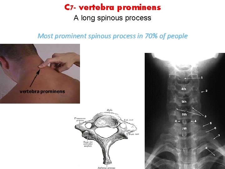 C 7 - vertebra prominens A long spinous process Most prominent spinous process in