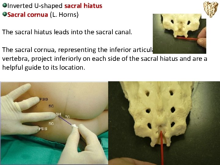 Inverted U-shaped sacral hiatus Sacral cornua (L. Horns) The sacral hiatus leads into the