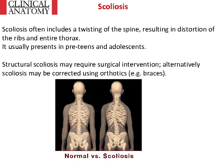 Scoliosis often includes a twisting of the spine, resulting in distortion of the ribs